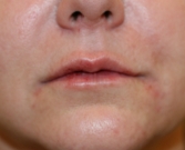 Feel Beautiful - Plump Lips and Turn Up Corners of Lips - After Photo